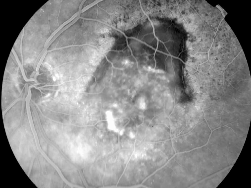 Fluorangiografia-Degenerazione-maculare-senile Fluorangiografia